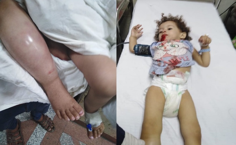 بالصور والمستندات.. طفلة كادت تفقد ساقيها بسبب خطأ طبي في مستشفي خاص بالمرج 