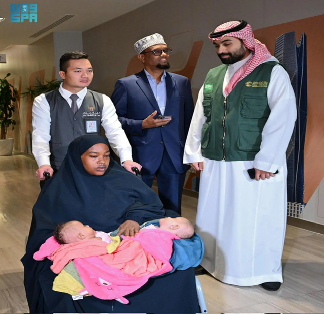 وصول التوأم الملتصق الصومالي 