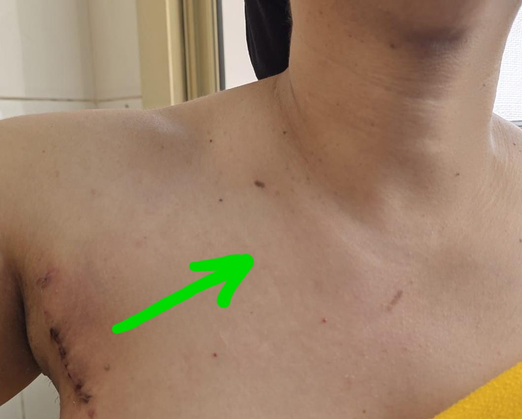 وداعا لشق الرقبة؟.. استئصال الغدة الدرقية بالمنظار من تحت الإبط في مستشفى أحمد ماهر