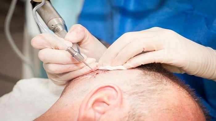 مات بعد يوم واحد من عملية تجميل كلفته 7158 دولار