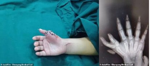 بالصور جراحة نادرة لاستئصال أربع أصابع من كفي طفلة مصابة بخلل وراثي