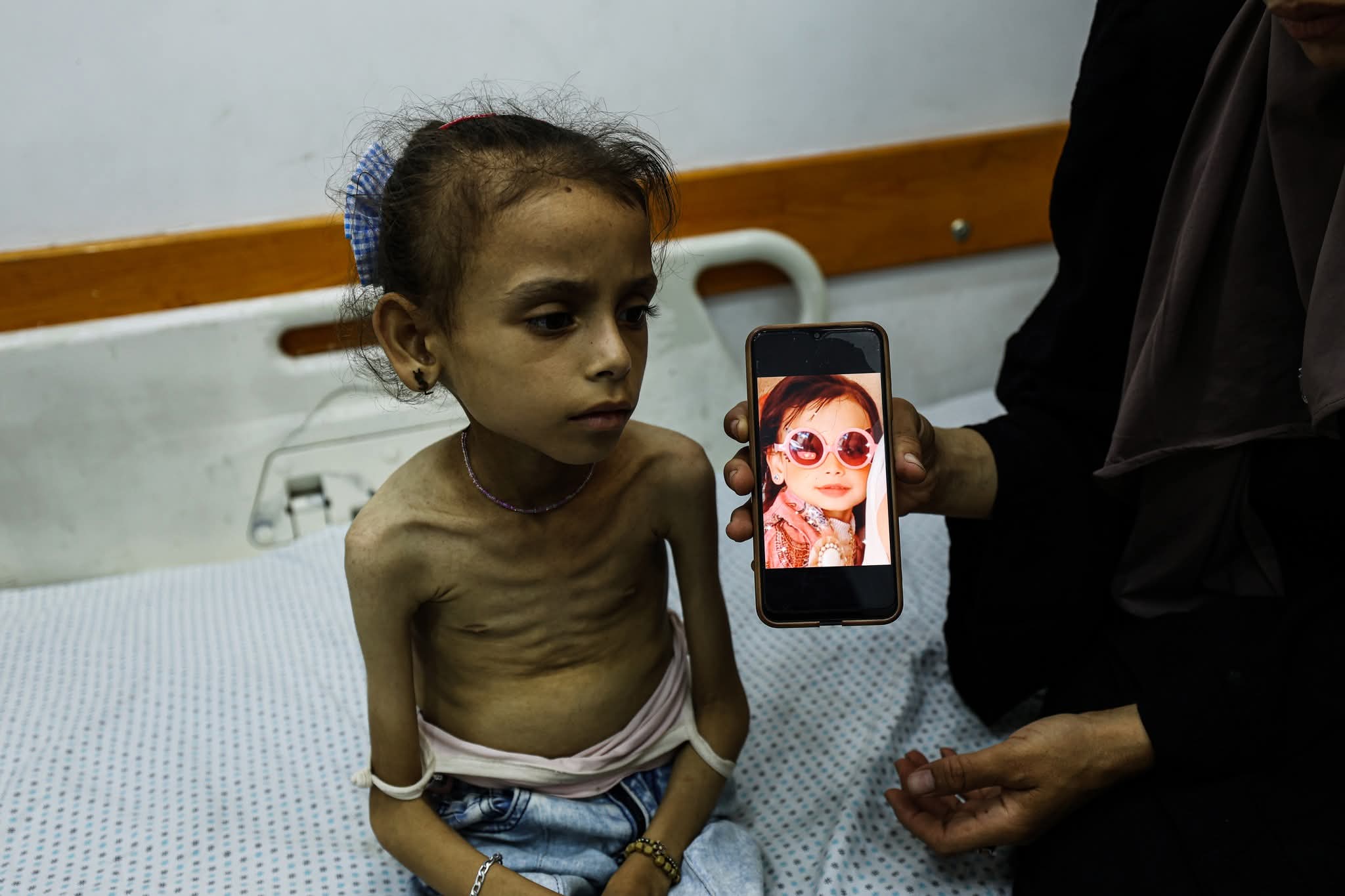 الجوع يقتل أطفال غزة: 63 وفاة بسوء التغذية في يوليو فقط

