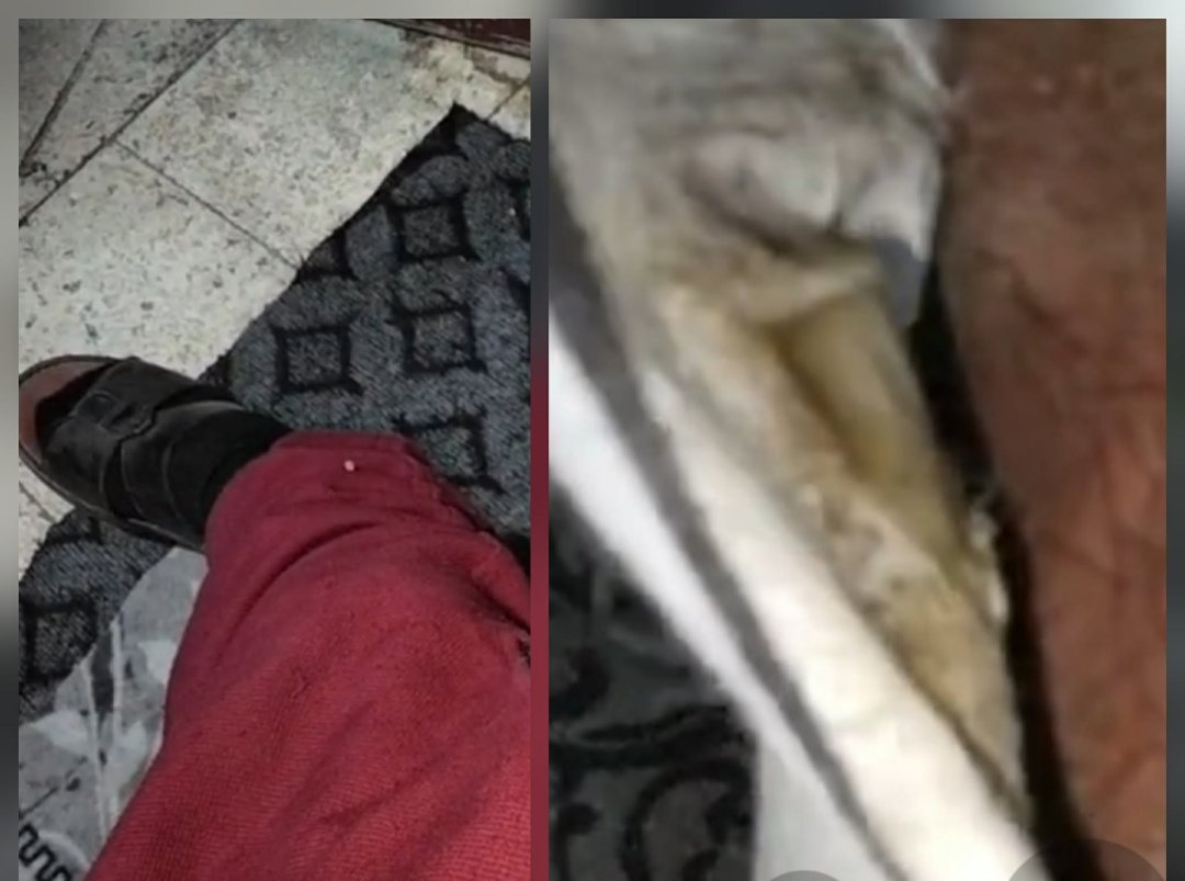 عامان من المعاناة في القصر العيني.. مريض بالبدرشين ينزف دون استجابة